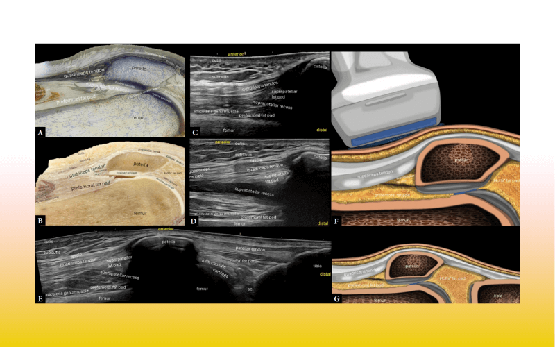 3. Compartimento anterior rodilla tempo formacion.png